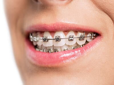 Preventing White Spots on Teeth During Braces Treatment - Vaught  Orthodontics