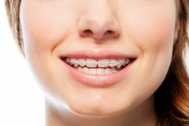 Ceramic Braces in Savannah and Richmond Hill, GA Vaught Orthodontics