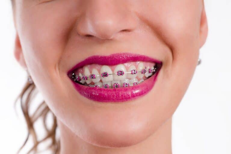 Can Orthodontics Improve Confidence in Savannah, GA? Vaught Orthodontics in Richmond Hill, GA